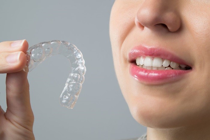 Những loại niềng răng phổ biến hiện nay