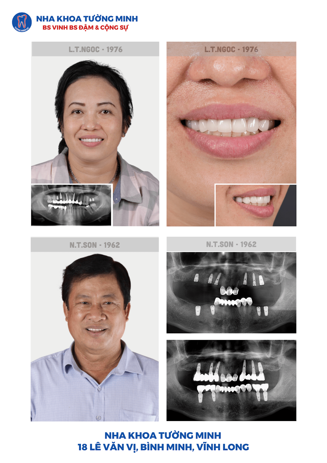 Ưu điểm - Nhược điểm của trồng răng Implant 