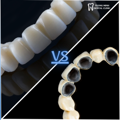 So sánh răng toàn sứ và răng sứ kim loại
